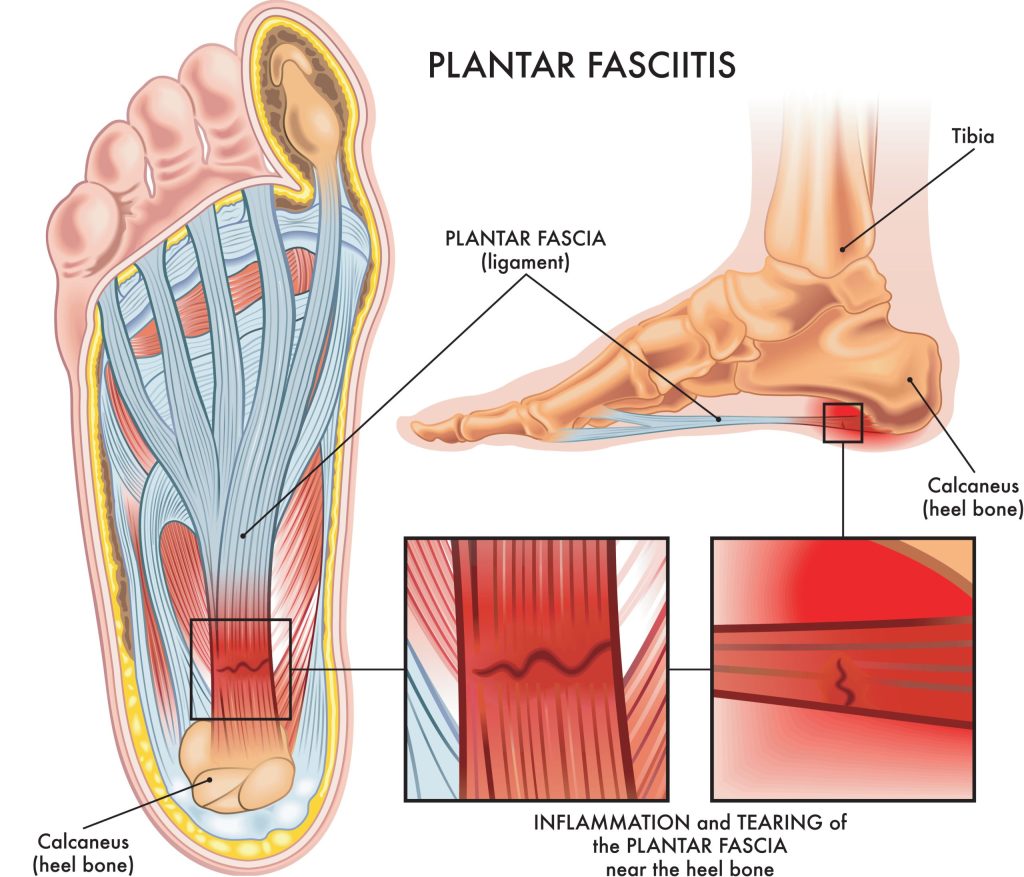 Diagram of the foot demonstrating the location of the plantar fascia ligament.
