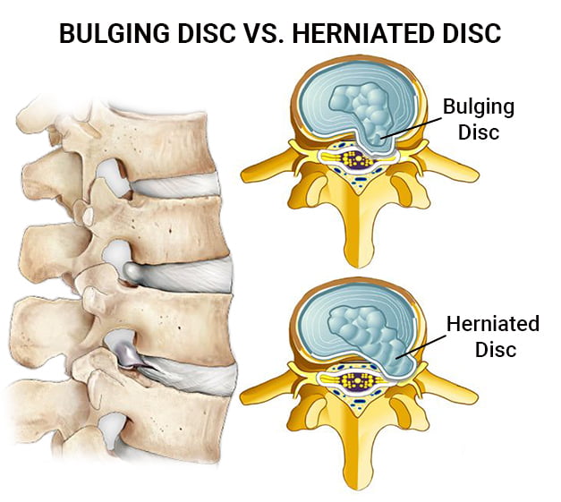 Diagram depicting the difference between a bulging disc and a herniated disc