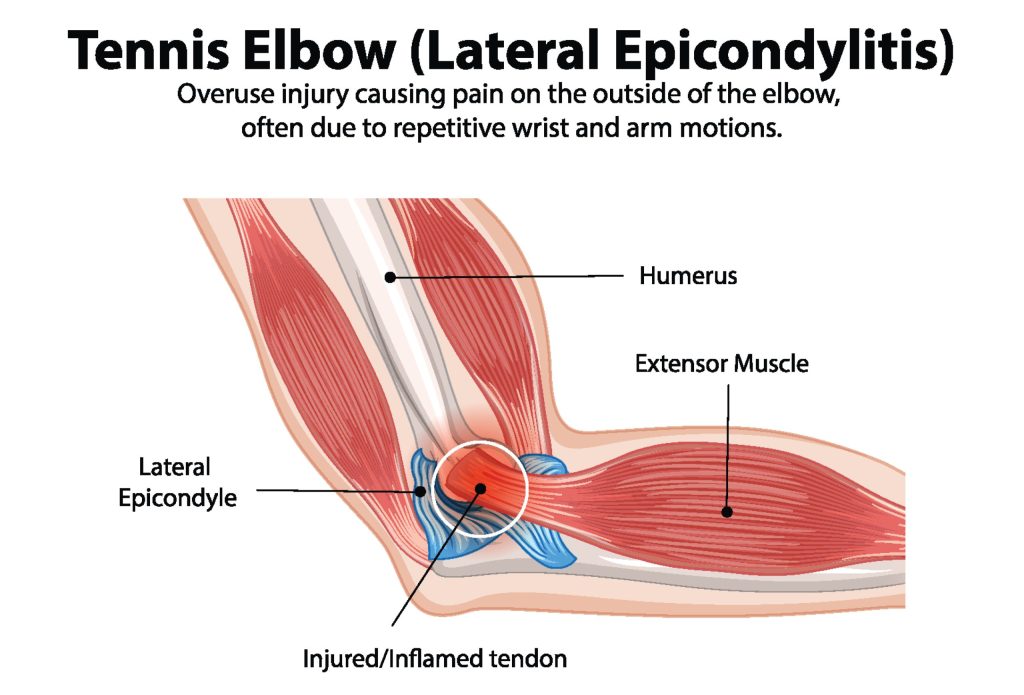 Diagram showing the anatomy of the elbow